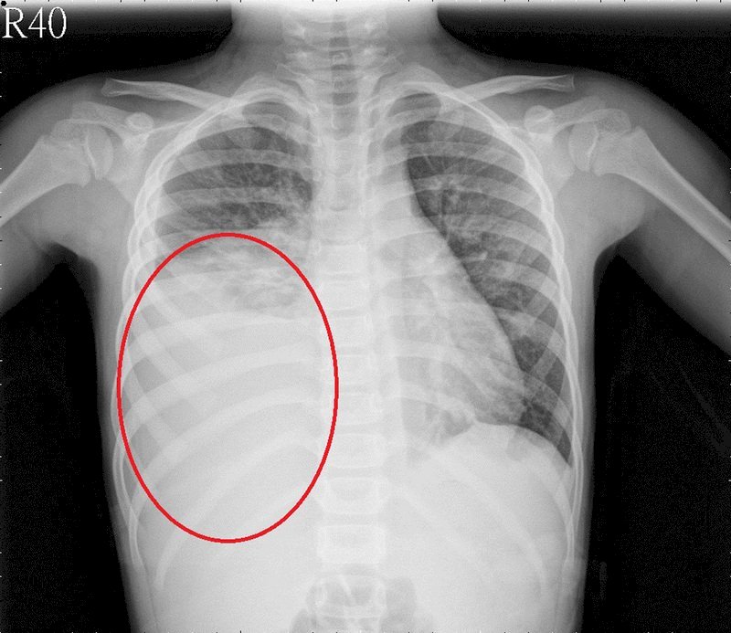 VIDEO: Mycoplasma pneumonia infections on the rise